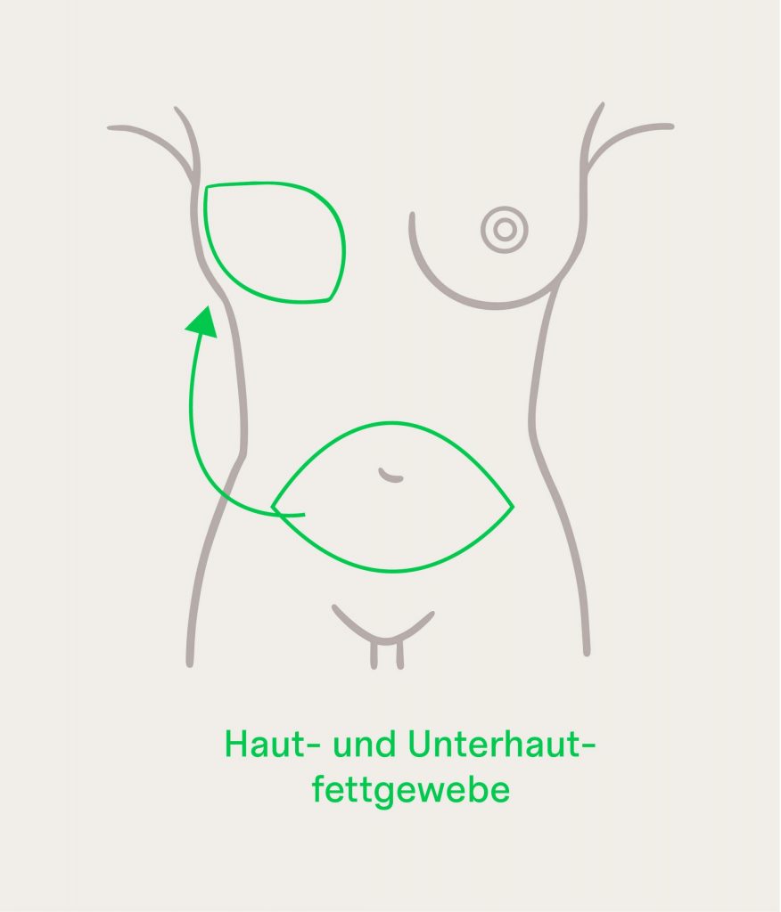 Grafik der Brustrekonstruktion mittels DIEP-Lappen-Chirurgie