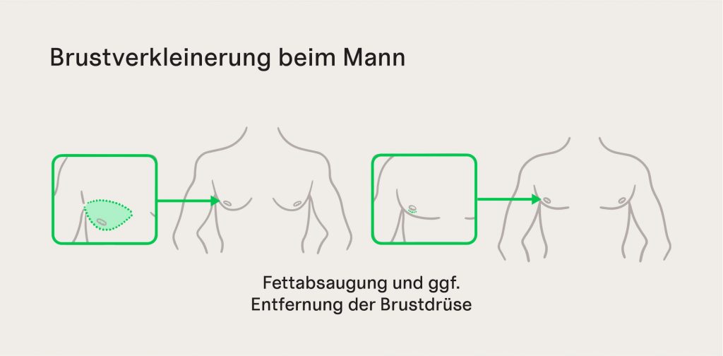 Abbildung einer Brustverkleinerung beim Mann