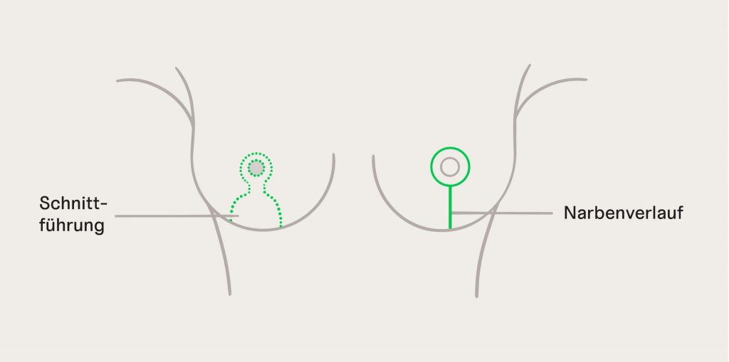 Grafik der Schnittführung bei einer Bruststraffung