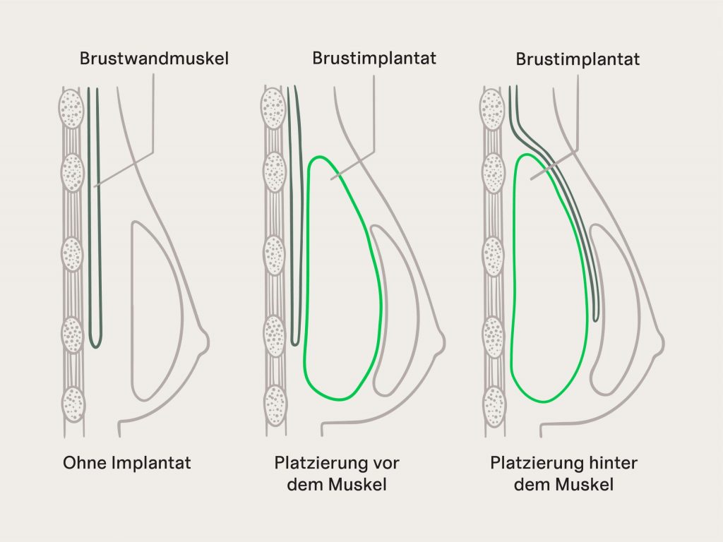 Grafik zur Platzierung der Brustimplantate vor oder hinter dem Brustmuskel